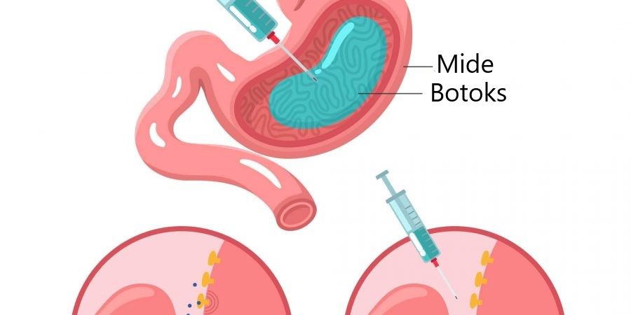 Mide Botoksu Diyeti
